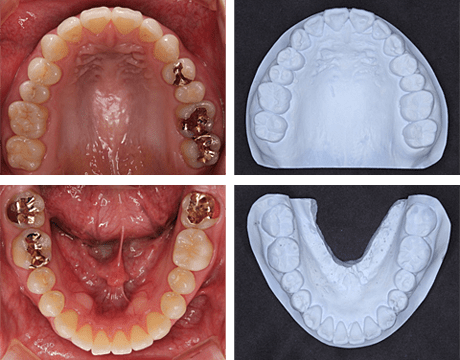 上下顎印象採得