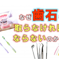 歯科 群馬 前橋 高崎 伊勢崎 桐生 太田 予防歯科 歯石 歯周病 歯磨き