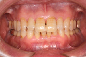 万代総合歯科診療所 群馬 歯科 歯周病 根管治療 インプラント治療 8020
